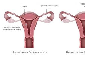 Всё о внематочной беременности — признаки, причины, лечение Как предотвратить внематочную беременность с одной трубой