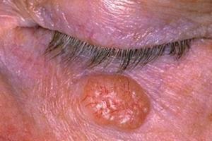 Базалиома – разновидость рака кожи: причины, классификация, симптомы и стадии, методы лечения и отзывы, фото Базальный плоскоклеточный рак кожи